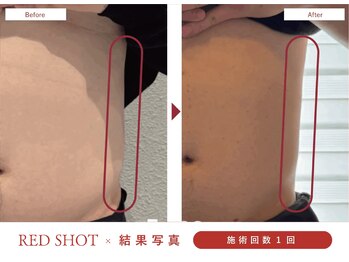 ハレア(HALEA)/レッドショット腹部 6cc B/A