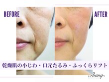 サンク(Thanq)/リフトアップはスマス筋土台から