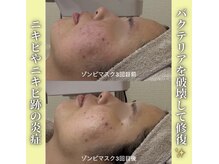 ハニエル(Haniel)/ゾンビマスク症例