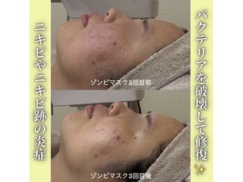 ハニエル(Haniel)/ゾンビマスク症例