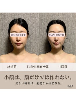 エレーニ 麻布十番(ELENI)/フェイスライン・頬位置・左右差