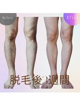 ララリア(LaLaLia)/男性全身脱毛