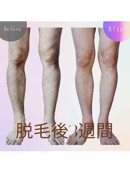 ララリア(LaLaLia)/男性全身脱毛