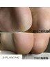 【県内希少】効果抜群【韓国式最先端角質ケア】S-PLANING 通常¥16,500