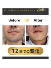 グロワール(gloire)/メンズに大人気☆ヒゲ脱毛