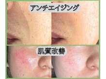 スリー ときわ台(Three)の雰囲気（悩んでいた赤み・しわ◎【ニードルピーリング施術前→施術後】）