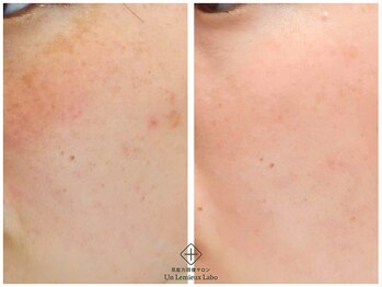アンレミューラボ(Un Lemieux Labo)/シミ、くすみ改善