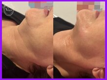 ヴィオール 名古屋栄店(VIOR)/光フェイシャルのバージョンUP