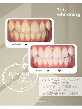スリール(sourire)/プレミアムホワイトニング