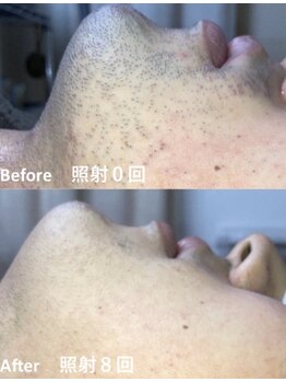 アンジュディ(A'nJUDY)/脱毛　ビフォーアフター