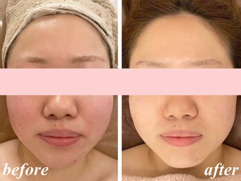 ピリナ 名古屋/【フォトRFピリナコース】症例