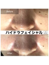 ビテキサロン ソワメーム(biteki salon SOI-MEME)/ハイドラフェイシャル