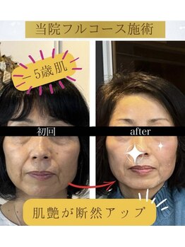 ユウェール(JUWEEL)/圧倒的ほうれい線・シミ集中ケア