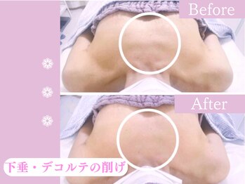 キアナ 横浜店(Kiana)/下垂にお悩みの方Before After