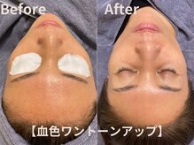 グレース 吉祥寺(grace)/肌が滑らかにトーンアップ