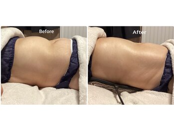 オリス(ORRIS)/お腹も浮腫みます(1回の変化)