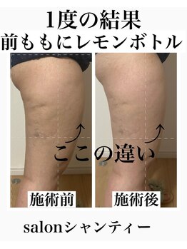 サロン シャンティー/足の脂肪が速攻で・・・