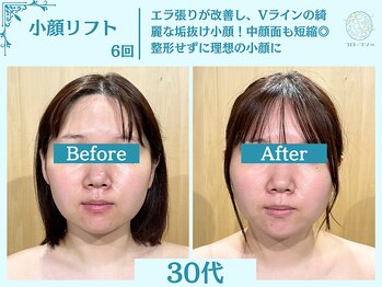 フローフシ∞/【小顔】切らない小顔リフト