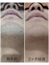 アカラ 読谷店(AKALA)/ヒゲ脱毛２か月経過