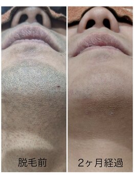 アカラ 読谷店(AKALA)/ヒゲ脱毛2か月経過