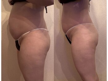 ルナ(Luna)/上半身◇痩身2回効果