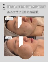 ラヴニール(L'avenir)/たった2回でニキビレスのお肌に