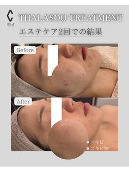 ラヴニール(L'avenir)/たった2回でニキビレスのお肌に