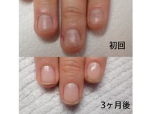 深爪、噛み爪でお悩みの方も3ヶ月で見違える変化！