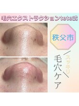 エミュ(emu)/毛穴エクストラクション