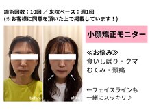 骨盤スタイル鍼灸整骨院 武蔵新城院(骨盤STYLE鍼灸整骨院)/小顔矯正