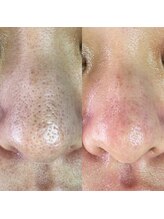 ミーミー 多治見店(MeMe.)/毛穴エクストラクション