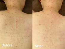 メゾンリュバン 梅田店(Maison Ruban)/背中ハーブピーリグ｜ブライダル