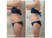 イリゼ(IRISER)の雰囲気(【ぽっこりお腹撃退】内臓脂肪、皮下脂肪取り除く!)