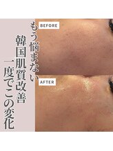 クラルテアンドコー(Salon Clarte&Co.)/韓国エステ版ポテンツァ♯1回