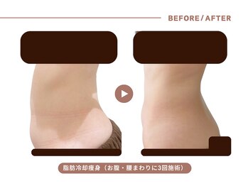 イエス マイサロン(yes My Salon)/脂肪冷却施術例