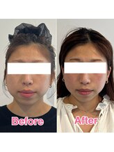 ヴィヴィアナ(viviana)/小顔矯正2ヶ月の変化！