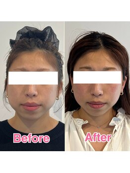 ヴィヴィアナ(viviana)/小顔矯正2ヶ月の変化!