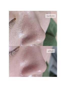 エミライ(emirai)/毛穴洗浄×顔脱毛で徹底ケア