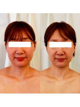 ミールーム(mi room)/フェイシャルマシン施術～２か月