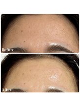 エース(ACE.)/おでこのハリUP！