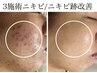 【夏の大感謝祭★継続相談】ニキビ/赤み跡★フォト×VC導入¥14,800→¥3500