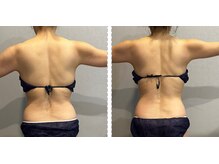 ラヴィエール(Laviere)/レディース痩身120分