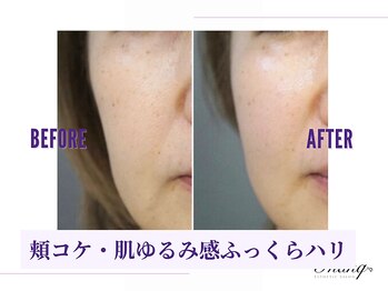 サンク(Thanq)/たるみ・もたつき・ゆるみケア