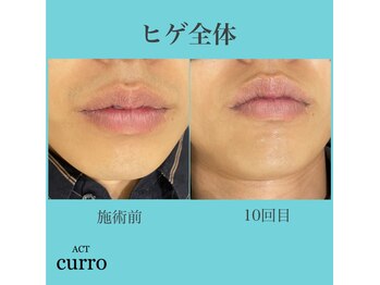アクト クロ(ACT curro)/【ヒゲ全体】脱毛施術例