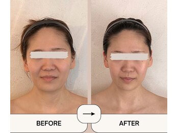 アメアラレ(amearare)/小顔コルギ 60分 5回施術