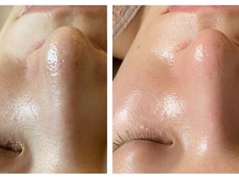 エミマス ボーテ(Emimas Beaute’)/３０代前半 毛穴洗浄1回　