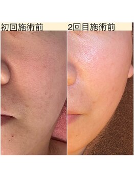 フルオール(FRUOR)/剥けないハーブピーリング