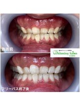 ホワイトニングサロン 名古屋駅店/【ホワイトニング施術例】