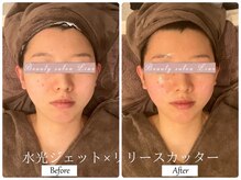 リノ(Lino)/リリースカッター×水光ジェット