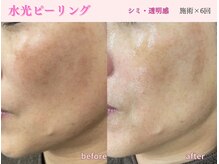 ミレット(Miretto)/【シミ・透明感】水光ピーリング